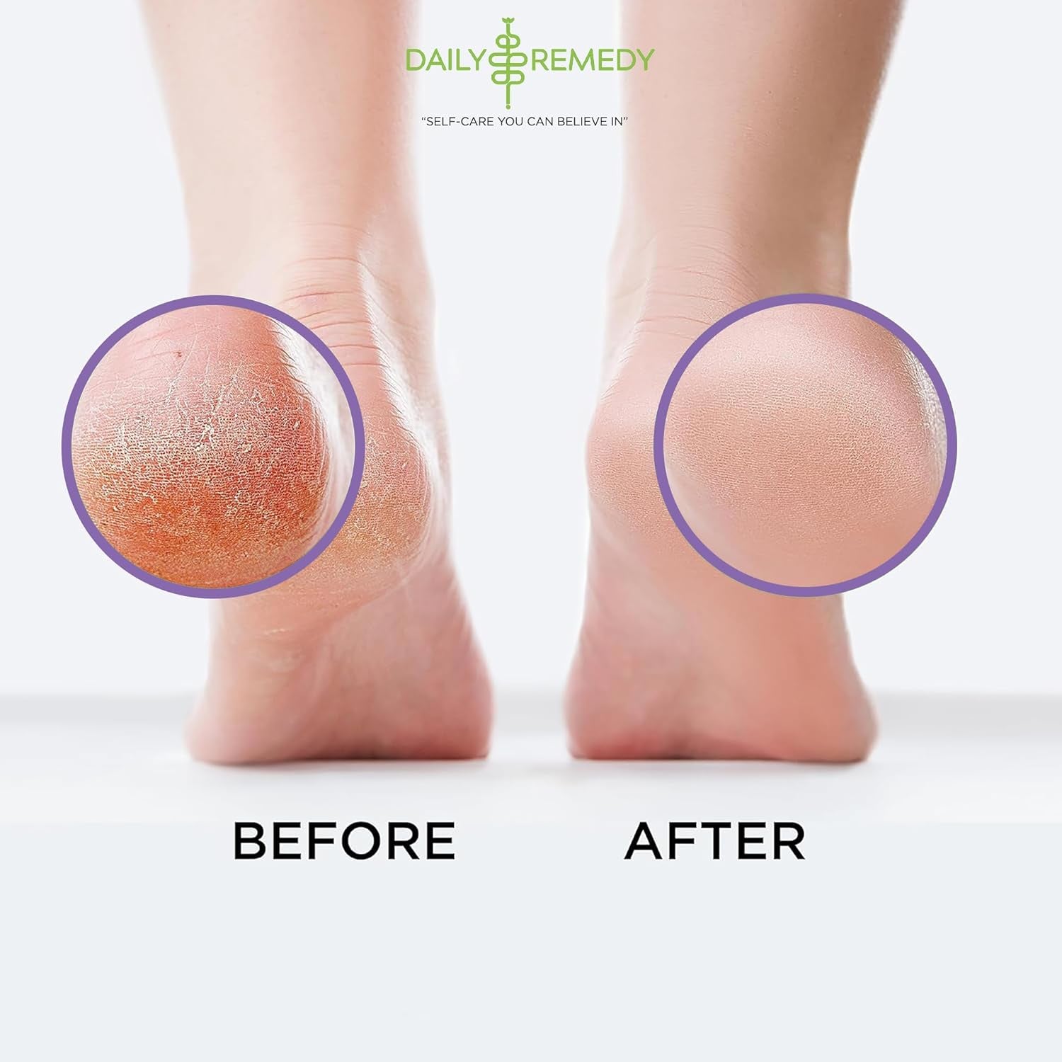 TREAT YOUR FEET Calming Lavender Foot Soak with Epsom Salt - 2 PACK - Soothes Sore Tired Feet, Athletes Foot & Remove Foot Odor